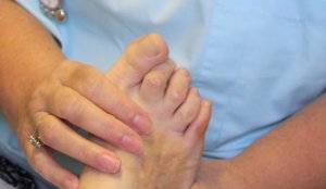 A podiatry patient's foot with corns