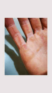 Callus on hand