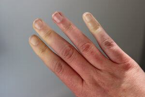 Raynaud's in fingers
